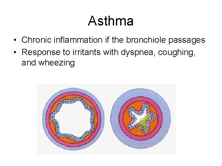Asthma • Chronic inflammation if the bronchiole passages • Response to irritants with dyspnea,