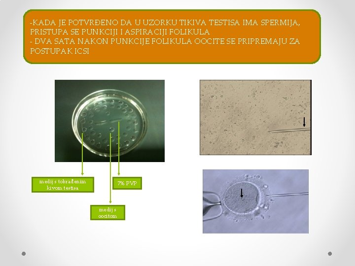 -KADA JE POTVRĐENO DA U UZORKU TIKIVA TESTISA IMA SPERMIJA, PRISTUPA SE PUNKCIJI I