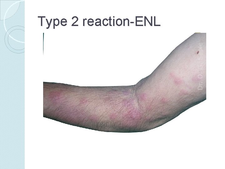 Type 2 reaction-ENL 