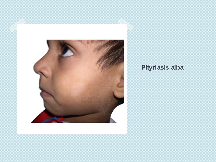 Pityriasis alba 