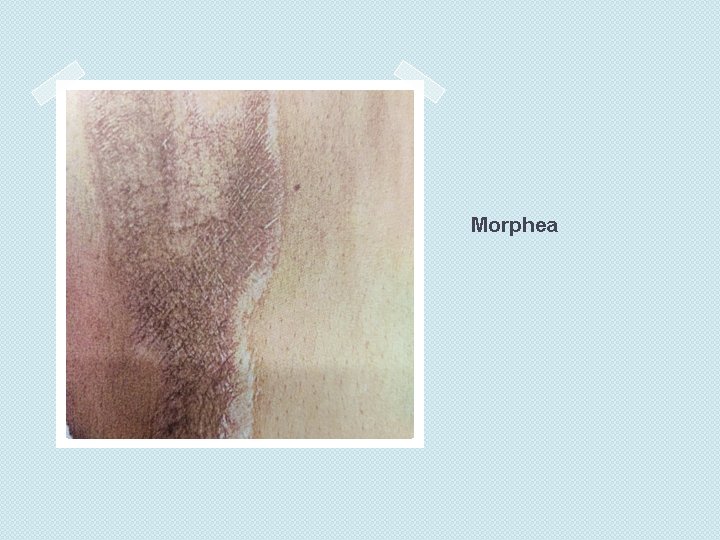 Morphea 