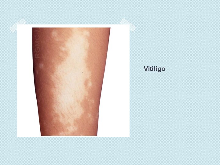 Vitiligo 