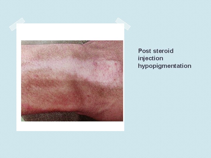 Post steroid injection hypopigmentation 