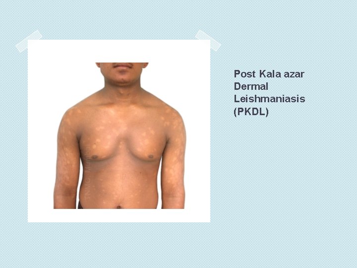 Post Kala azar Dermal Leishmaniasis (PKDL) 