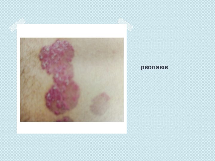 psoriasis 