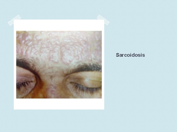 Sarcoidosis 