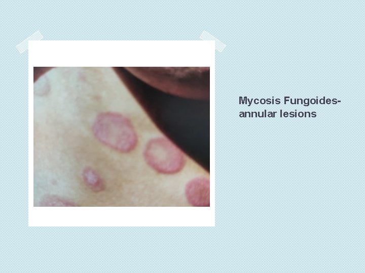 Mycosis Fungoidesannular lesions 