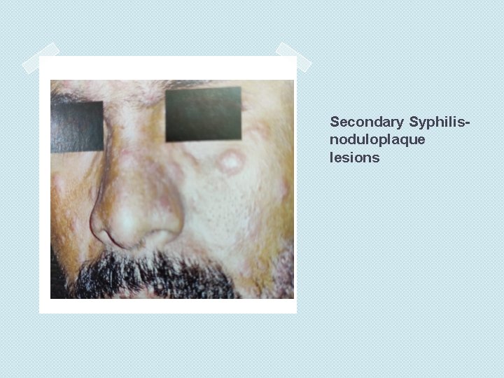 Secondary Syphilisnoduloplaque lesions 