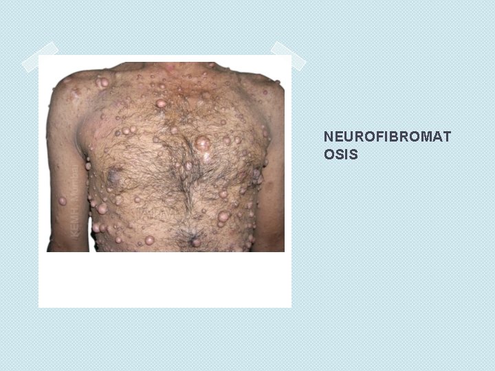 NEUROFIBROMAT OSIS 