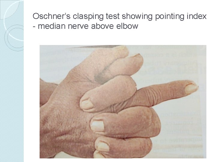 Oschner’s clasping test showing pointing index - median nerve above elbow 