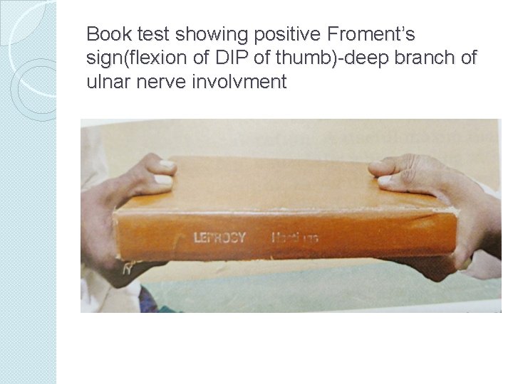 Book test showing positive Froment’s sign(flexion of DIP of thumb)-deep branch of ulnar nerve