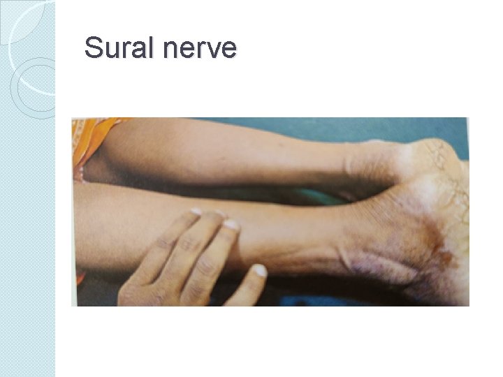 Sural nerve 