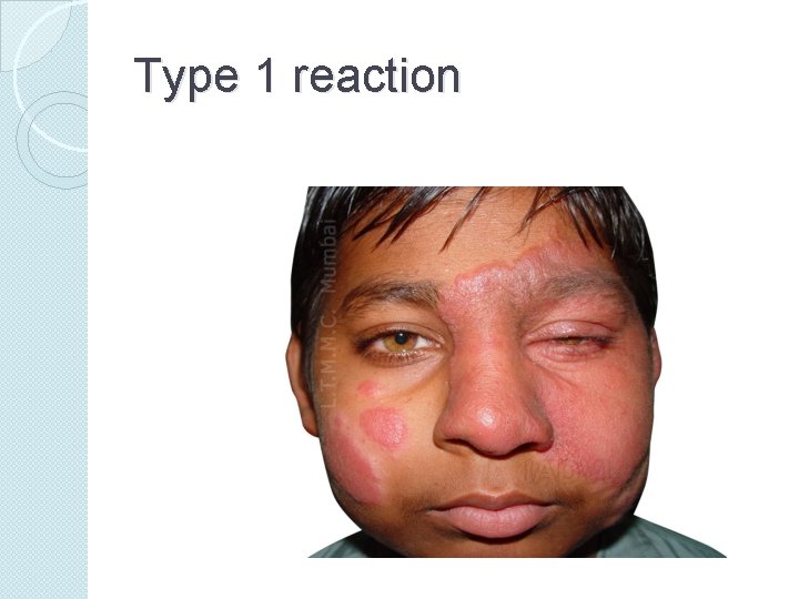 Type 1 reaction 