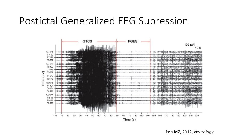 Postictal Generalized EEG Supression Poh MZ, 2012, Neurology 