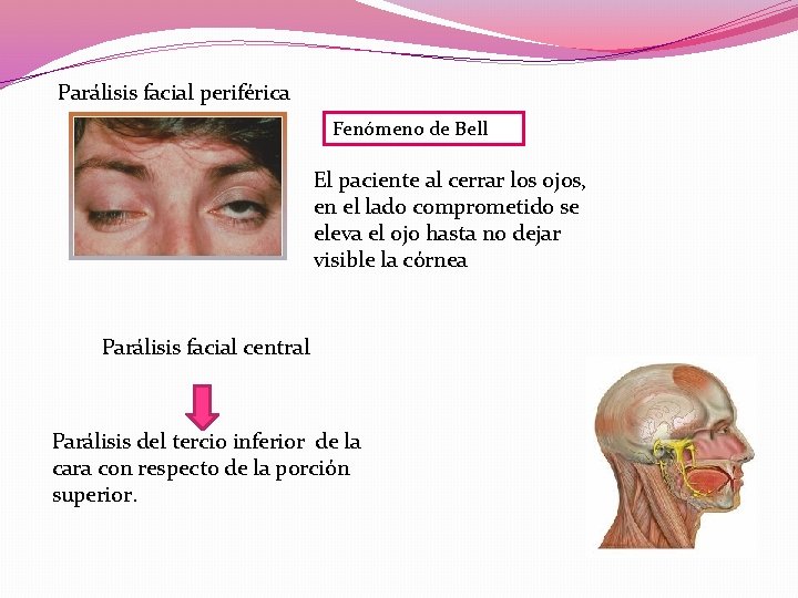 Parálisis facial periférica Fenómeno de Bell El paciente al cerrar los ojos, en el