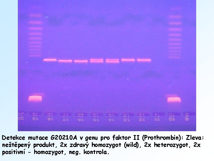 Detekce mutace G 20210 A v genu pro faktor II (Prothrombin): Zleva: neštěpený produkt,