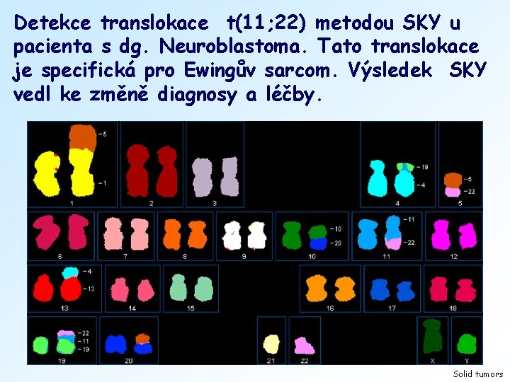 Detekce translokace t(11; 22) metodou SKY u pacienta s dg. Neuroblastoma. Tato translokace je