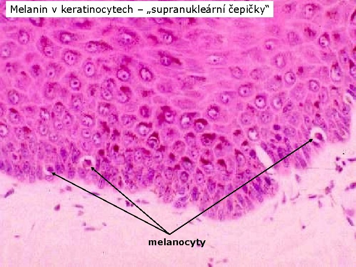 Melanin v keratinocytech – „supranukleární čepičky“ melanocyty 