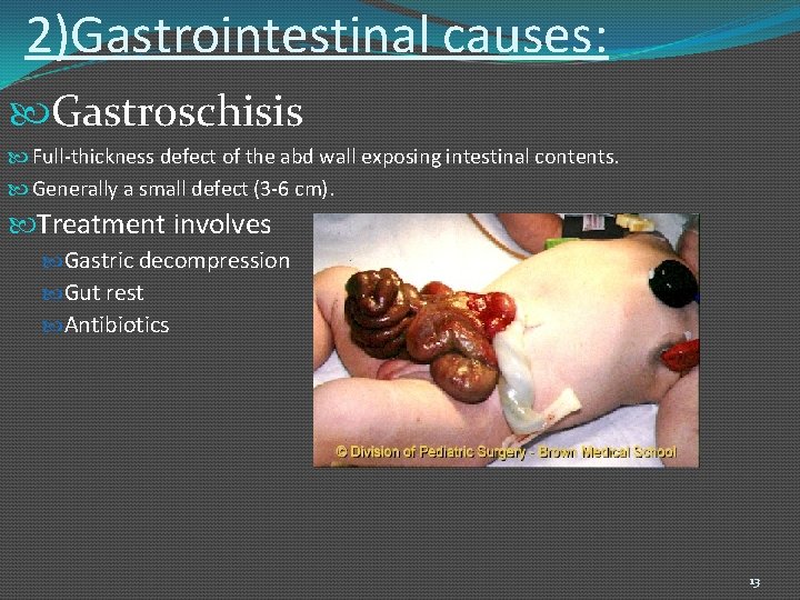 2)Gastrointestinal causes: Gastroschisis Full-thickness defect of the abd wall exposing intestinal contents. Generally a
