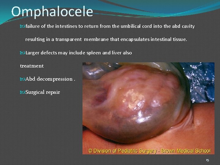 Omphalocele failure of the intestines to return from the umbilical cord into the abd