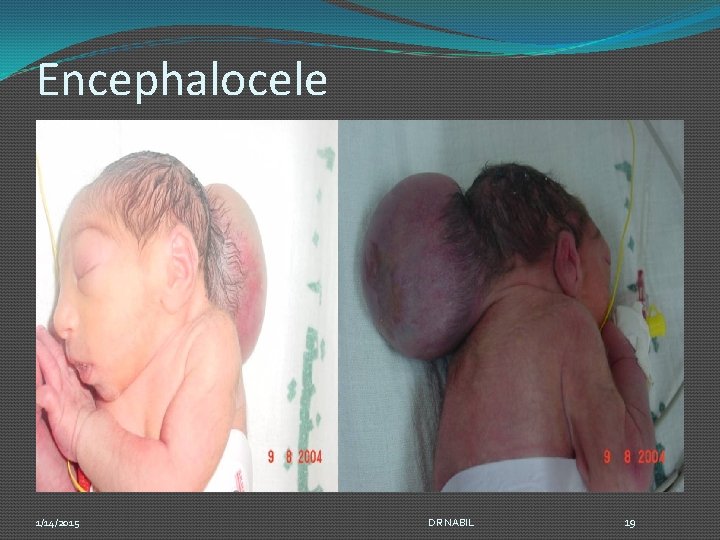 Encephalocele 1/14/2015 DR NABIL 19 