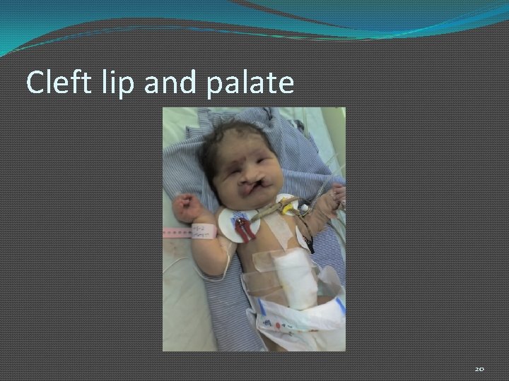 Cleft lip and palate 20 