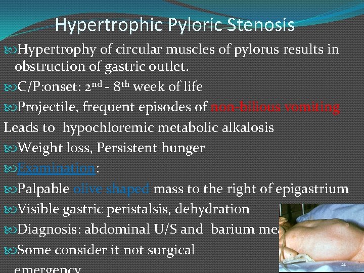 Hypertrophic Pyloric Stenosis Hypertrophy of circular muscles of pylorus results in obstruction of gastric
