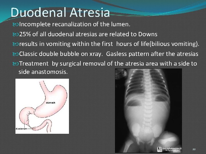 Duodenal Atresia Incomplete recanalization of the lumen. 25% of all duodenal atresias are related