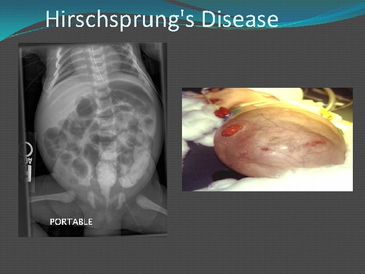 Hirschsprung's Disease 