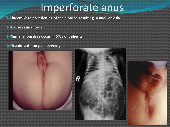 Imperforate anus incomplete partitioning of the cloacae resulting in anal atresia. Cause is unknown