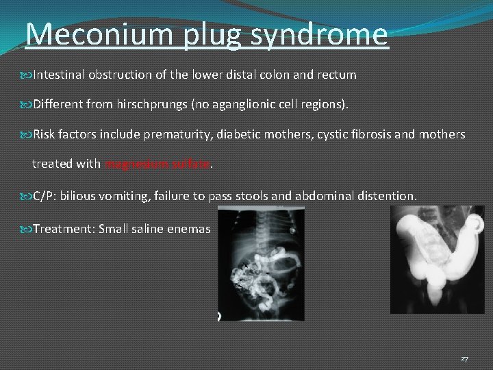 Meconium plug syndrome Intestinal obstruction of the lower distal colon and rectum Different from