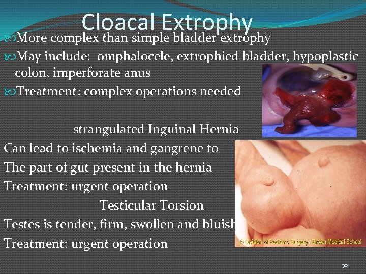 Cloacal Extrophy More complex than simple bladder extrophy May include: omphalocele, extrophied bladder, hypoplastic