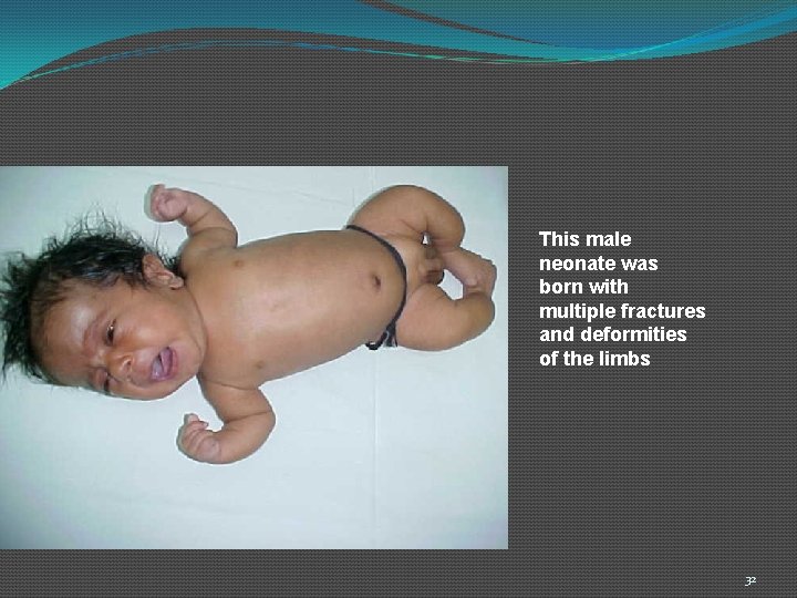 This male neonate was born with multiple fractures and deformities of the limbs 32