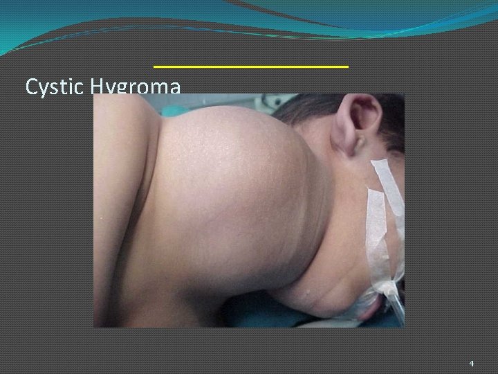 Cystic Hygroma 4 