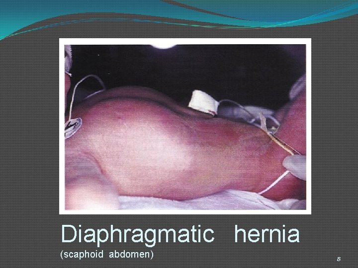 Diaphragmatic hernia (scaphoid abdomen) 8 