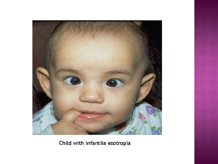 Child with infantile esotropia 