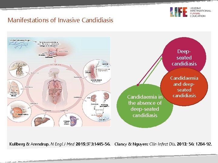 Manifestations of Invasive Candidiasis Deepseated candidiasis Candidaemia in the absence of deep-seated candidiasis Kullberg Manifestations of Invasive Candidiasis Deepseated candidiasis Candidaemia in the absence of deep-seated candidiasis Kullberg