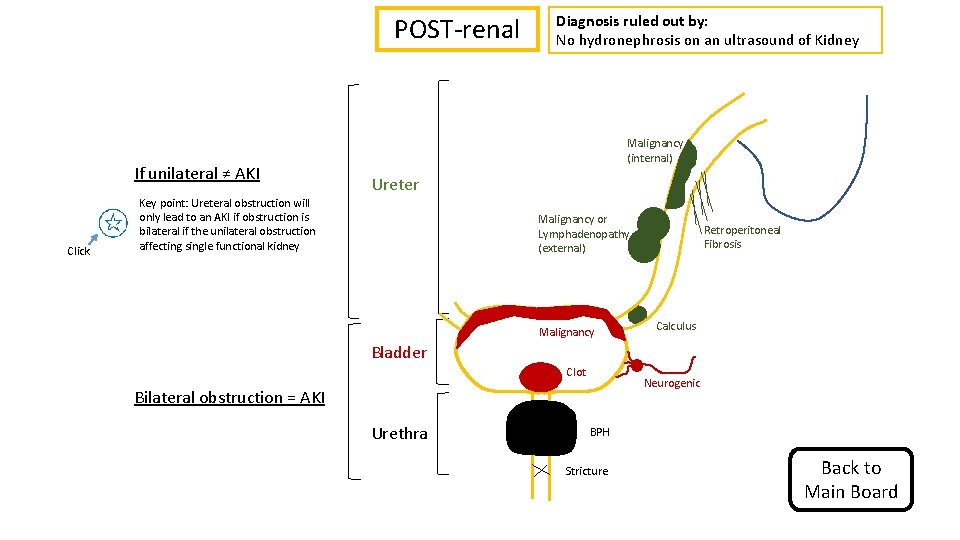 POST-renal If unilateral ≠ AKI Click Key point: Ureteral obstruction will only lead to POST-renal If unilateral ≠ AKI Click Key point: Ureteral obstruction will only lead to