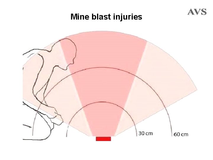 Mine blast injuries 