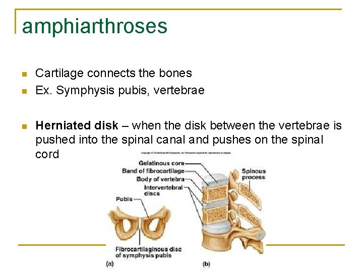 amphiarthroses n n n Cartilage connects the bones Ex. Symphysis pubis, vertebrae Herniated disk