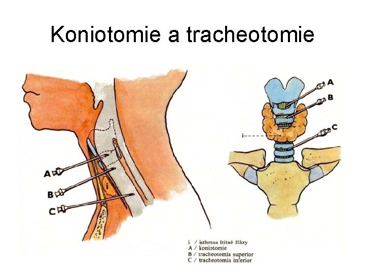 Koniotomie a tracheotomie 