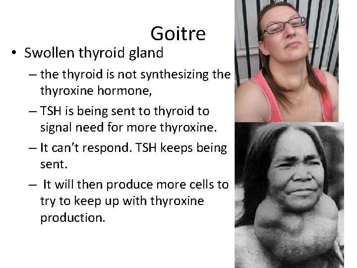Goitre • Swollen thyroid gland – the thyroid is not synthesizing the thyroxine hormone,