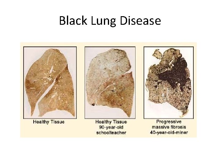 Black Lung Disease 
