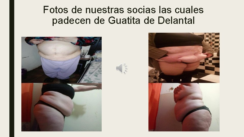 Fotos de nuestras socias las cuales padecen de Guatita de Delantal 