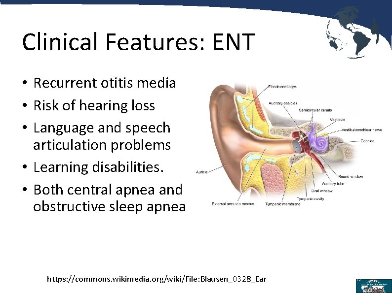 Clinical Features: ENT • Recurrent otitis media • Risk of hearing loss • Language