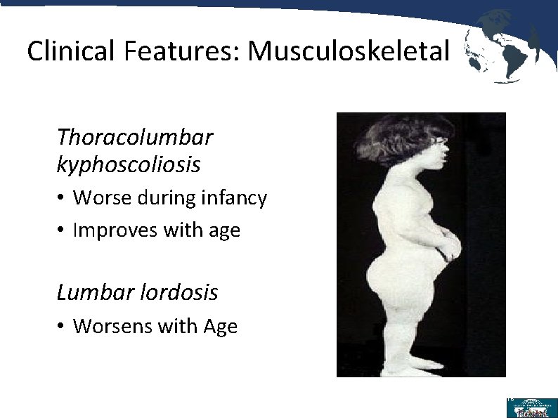 Clinical Features: Musculoskeletal Thoracolumbar kyphoscoliosis • Worse during infancy • Improves with age Lumbar
