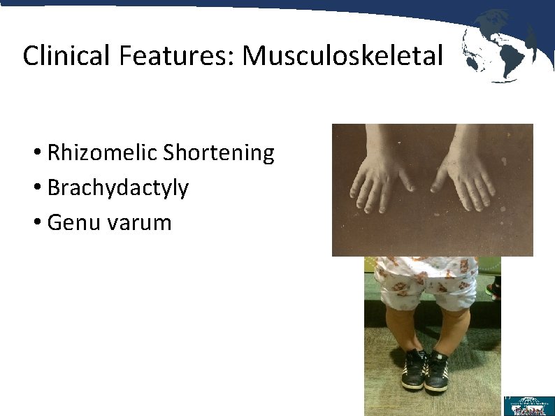 Clinical Features: Musculoskeletal • Rhizomelic Shortening • Brachydactyly • Genu varum 17 