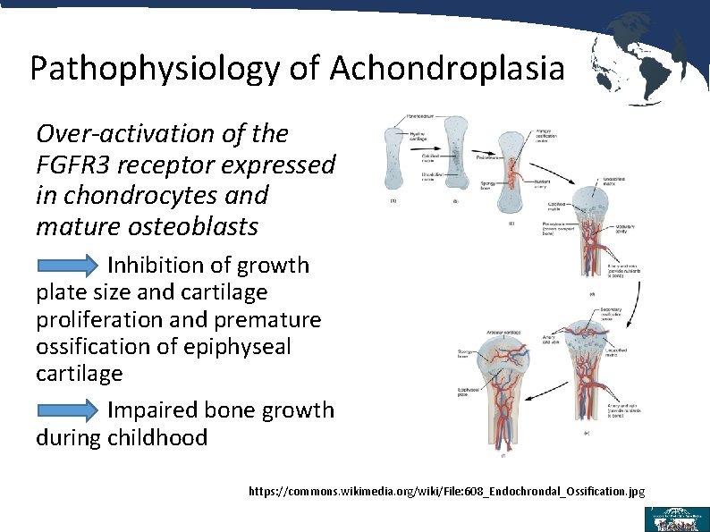 Pathophysiology of Achondroplasia Over-activation of the FGFR 3 receptor expressed in chondrocytes and mature