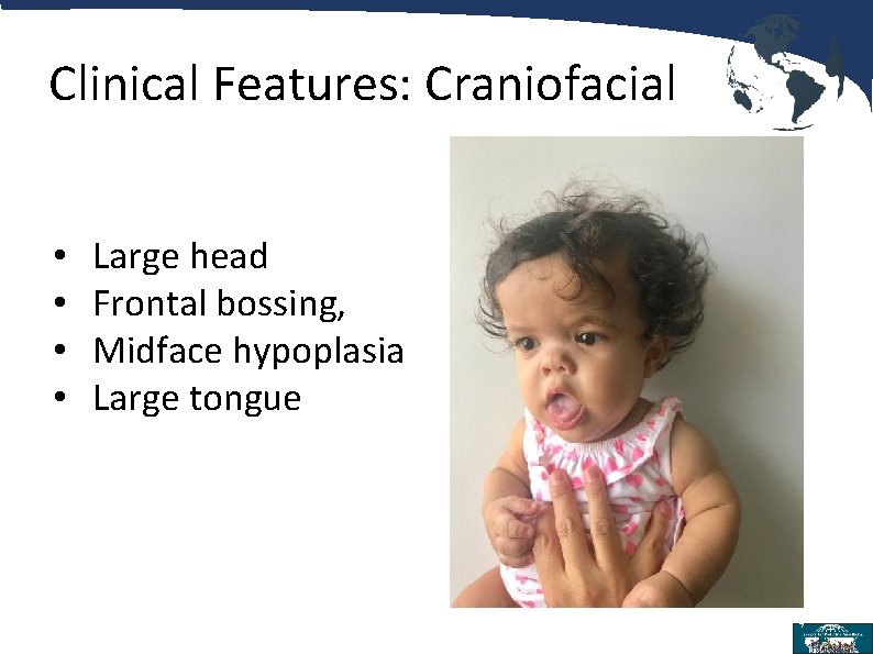 Clinical Features: Craniofacial • • Large head Frontal bossing, Midface hypoplasia Large tongue 9