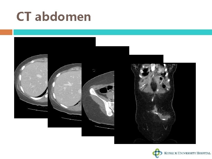 CT abdomen 